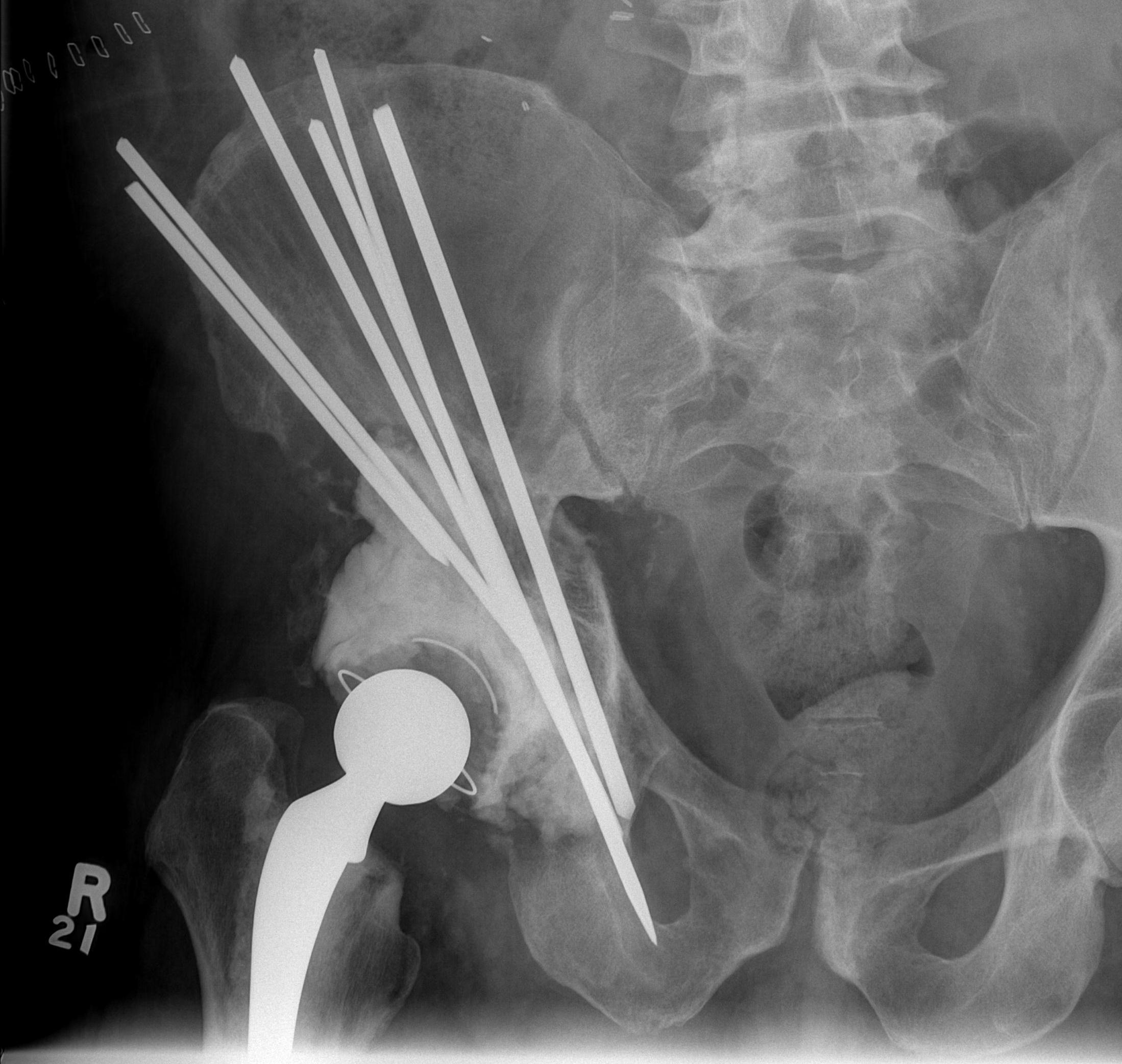 Acetabular Metastasis Steinman Pins